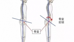 “前凸后翘”好身材？当心骨盆前倾哟！