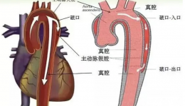 胸背部撕裂样疼痛 警惕主动脉夹层