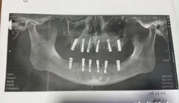 拔牙科普