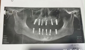 拔牙科普