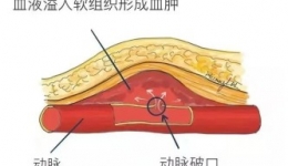 超声引导下股动脉假性动脉瘤凝血酶注入封闭术健康宣教