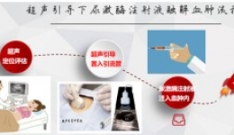 超声引导下尿激酶注射软组织内血肿抽吸术健康教