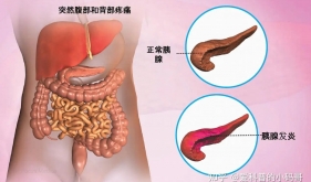 生死时速！重症医学科击退重症胰腺炎