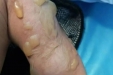 又到高发期！小儿烧烫伤怎么办？