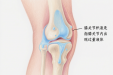 认识“膝关节积液”