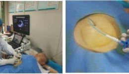 精准微创，解除“巨大囊肿”困扰，门诊就能做