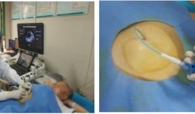 精准微创，解除“巨大囊肿”困扰，门诊就能做