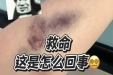 抽血后手臂淤青？教你3招按出“无痕手臂”，长辈小孩都能用！