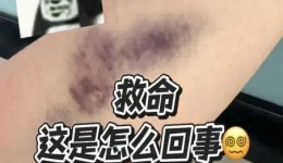抽血后手臂淤青？教你3招按出“无痕手臂”，长辈小孩都能用！