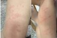 身上突然冒出红斑块，还痒到想扒皮······这病咋就盯上我了？