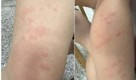 身上突然冒出红斑块，还痒到想扒皮······这病咋就盯上我了？