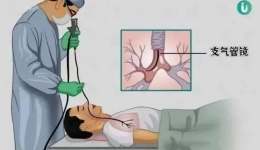 肺部“侦察兵”——让肺部隐患无所遁形