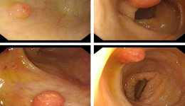 肠道里有“小蘑菇”：别慌，大多是“乖宝宝”