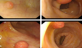 肠道里有“小蘑菇”：别慌，大多是“乖宝宝”