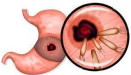 吹口气，揪出胃病元凶！——全新碳13检查，无痛无创查幽门！