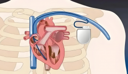 装了心脏起搏器，该注意哪些问题？