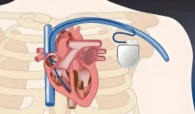 装了心脏起搏器，该注意哪些问题？