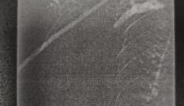 四川天府新区人民医院肾内科成功开展新区首例中心静脉球囊扩张并支架置入术