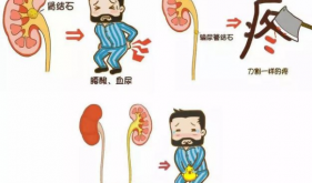 结石疼到直不起腰？双能量检查帮你快速 “锁定” 元凶