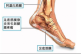 走路像走刀子，小“美人鱼”的酷刑体验——足底筋膜炎