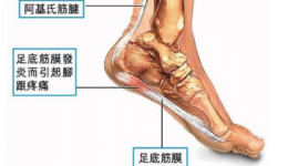 走路像走刀子，小“美人鱼”的酷刑体验——足底筋膜炎