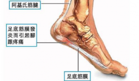 走路像走刀子，小“美人鱼”的酷刑体验——足底筋膜炎