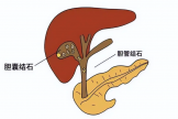胆囊结石怎么防？怎么治？这篇指南讲透了！