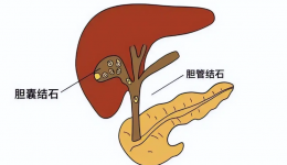 胆囊结石怎么防？怎么治？这篇指南讲透了！