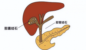 胆囊结石怎么防？怎么治？这篇指南讲透了！
