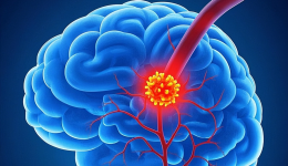 【健康科普・医路护航】冬季，为何脑梗容易找上门？