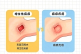 【健康科普・医路护航】瘢痕别乱治！增生性瘢痕与瘢痕疙瘩根本不是一回事！