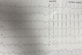 生命至上不等待 绿色通道护心安 | 胸痛中心多学科协作成功救治心脏骤停心梗患者