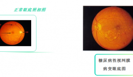 【健康科普・医路护航】糖尿病视网膜病变，糖友必看的眼底 “隐形杀手”